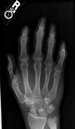 Perilunate Dislocation Radiology Reference Article Radiopaedia Org