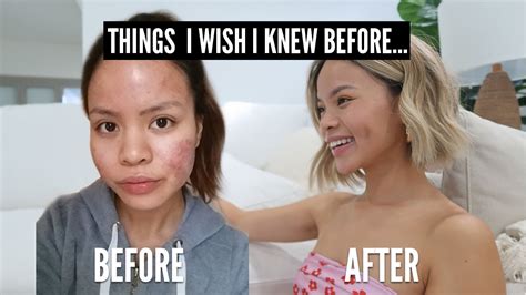 All The Things I Wish I Knew Before Acne Youtube