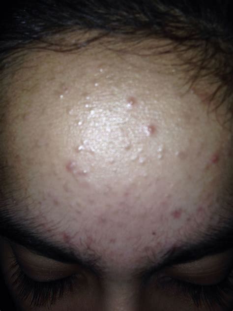 How To Get Rid Of Flesh Coloured Bumps On Face Yahoo Small Red Dots On