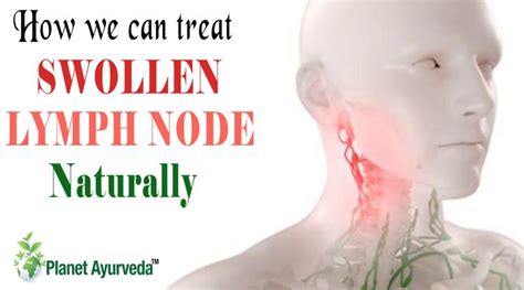 Natural Treatments For The Swollen Lymph Node Archives Planet Ayurveda