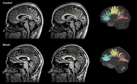 A midsagittal view of the corpus callosum from the T1-weighted ...