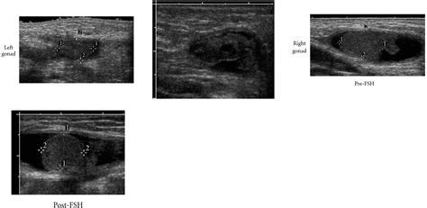 fsh injections and ultrasonography determine presence of ovarian components in the evaluation of
