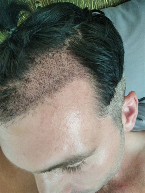 Second Hair Transplant From Nightmare To Hope Hair Loss Forum Hair