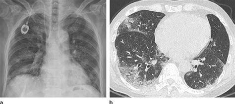 Check spelling or type a new query. Influenza A viral pneumonia in a patient undergoing ...