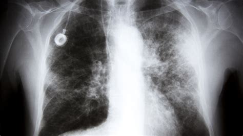 Daily Dose Treating Stage Iv Lung Cancer With A Pill