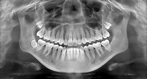 The Truth About Dental X Rays Center For Restorative And Cosmetic Dentistry