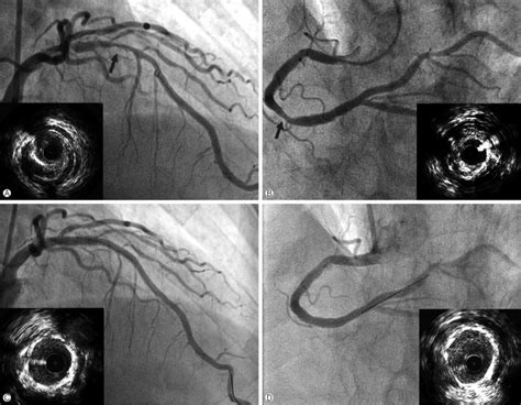 Coronary Angiography And Intravascular Ultrasound Left Coronary