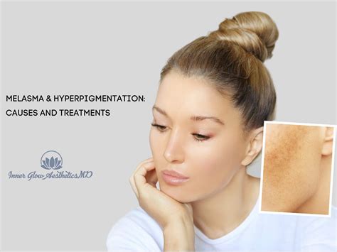 Melasma And Hyperpigmentation Causes And Treatments Inner Glow
