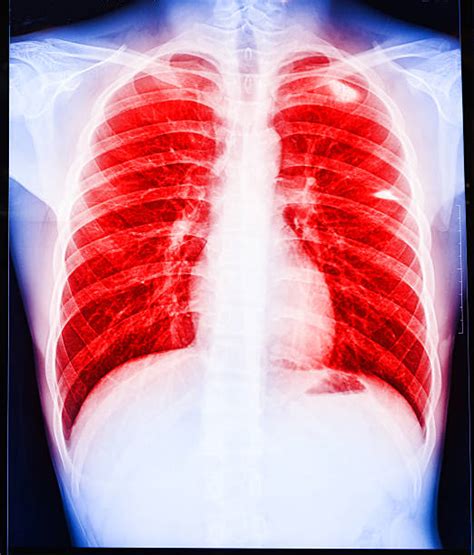 Lung Infection Stock Photos Pictures And Royalty Free Images Istock