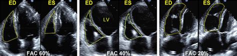 Is Mri The Preferred Method For Evaluating Right Ventricular Size And