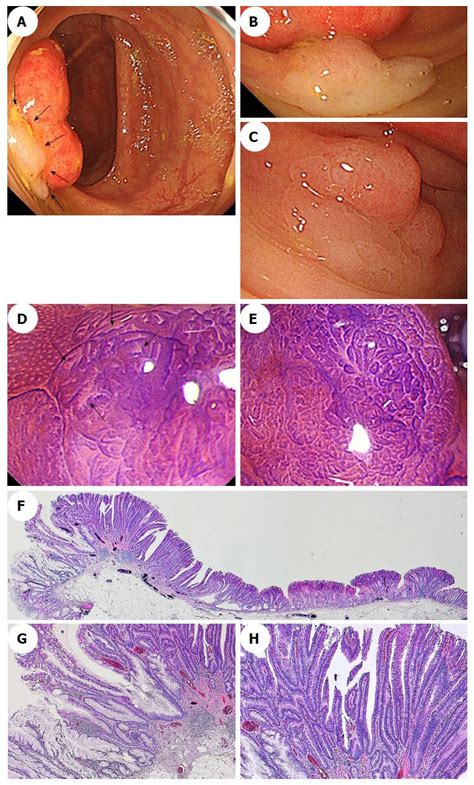 Endoscopic Diagnosis Of Sessile Serrated Adenoma Polyp With And Without