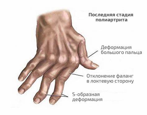 Ревматоидный полиартрит диета при полиартрите Ревматоидный артрит пальцев рук: первые симптомы, лечение Ревматоидный артрит пальцев рук: первые симптомы, лечение Ревматоидный полиартрит диета при полиартрите