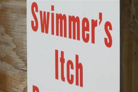 Swimmers Itch Causes Microscopic Yet Big Problem In Roscommon County