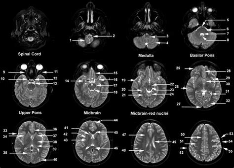 Nuclear Medicine Imaging Of Cns Basis And Clinical Applications