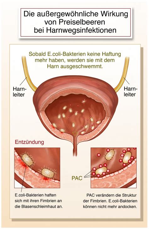 Blasenentzündung Im Sommer Diese Tipps Helfen Naturheilkunde