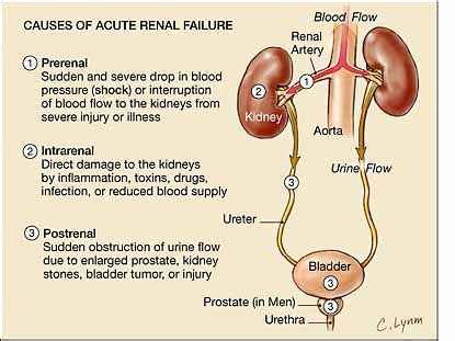Some people have symptoms of kidney failure while others do not; Acute Renal Failure Nursing Care Plan & Management - RNpedia