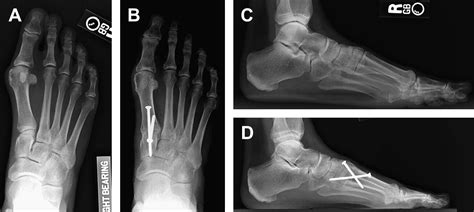 Early Weightbearing Of The Lapidus Bunionectomy Clinics In Podiatric