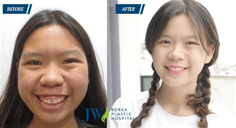 Double Jaw Surgery Change Your Face Jw Korea Plastic Hospital