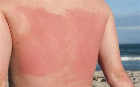 Can The Sun Cause Eczema