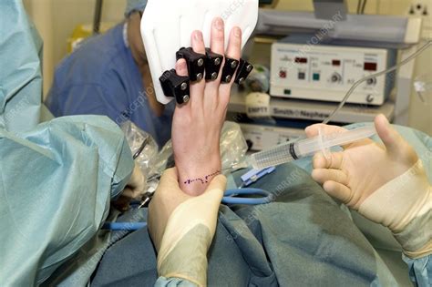 Anaesthetic In Arthroscopic Wrist Surgery Stock Image C Science Photo Library