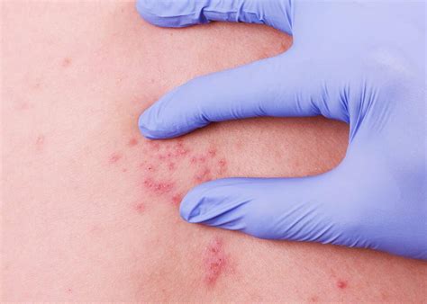 Shingles Causes And Treatments Dermatology Inc