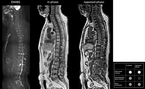 Expanding Whole Body Mri Use In Oncology Patients Philips