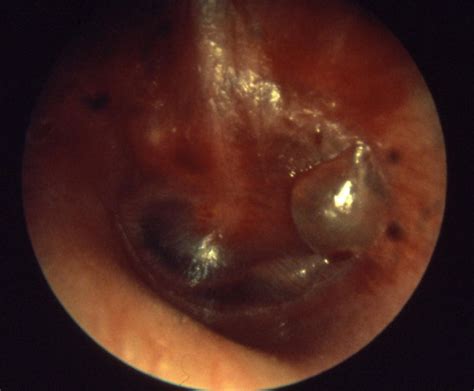Otitis Media Other Imaging Findings Wikidoc