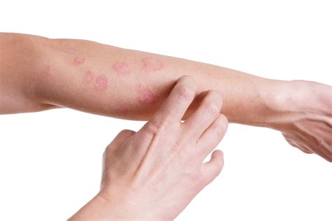 Como Tratar E Identificar A Alergia Na Pele