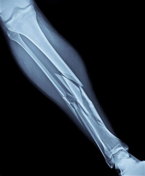 Treatments For A Broken Bone Movement Orthopedics