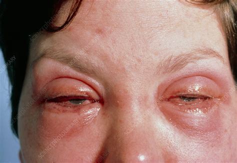 Woman S Eyes Inflamed Due To Make Up Allergy Stock Image M320 0137 Science Photo Library
