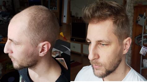 Haarausfall ist ein problem, welches männer und frauen gleichermaßen extrem belasten kann. Die Haartransplantation Erfahrungen des Youtubers Meezy Beezy