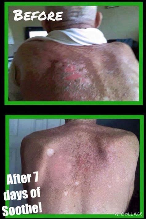 Radiation Therapy Caused These Burn And After Soothe Was Used For 7 Days Look At The