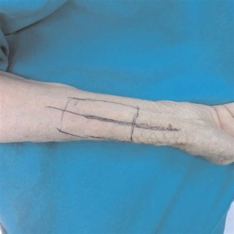 Reconstruction With Free Radial Forearm Flap After Tumor Excision Download Scientific Diagram