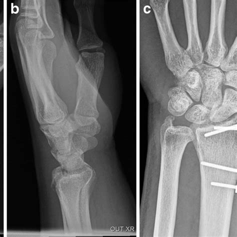 Minimally Invasive Surgery Is There A Role In Distal Radius Fracture
