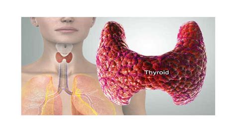 Thyromegaly Types Causes Symptoms Diagnosis And Treatment