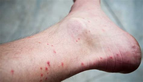 Can Dog Rash Spread To Humans