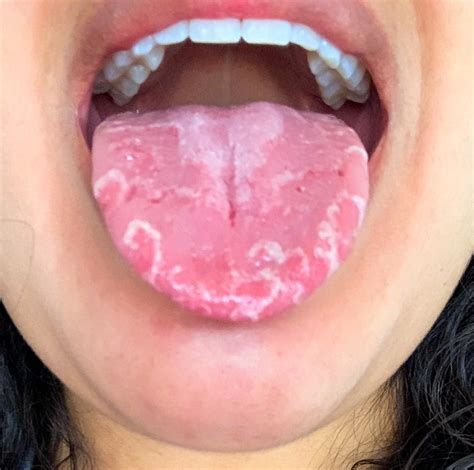 My Geographic Tongue During Allergy Season Rmildlyinteresting