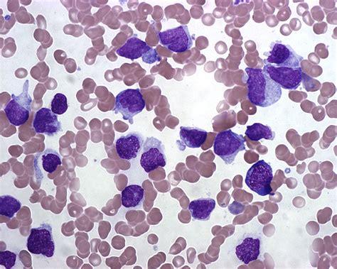 Blastic Plasmacytoid Dendritic Cell Neoplasm Surgical Pathology Clinics