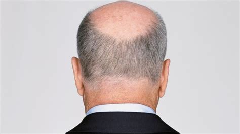 Hats Off To These 4 Potential Baldness Cures Abc News