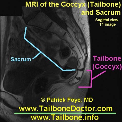 Tailbone Images For Coccyx Pain Tailbone Doctor