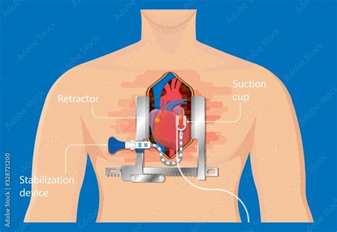 Coronary Artery Bypass Grafting Cabg Open Heart Surgery Surgical