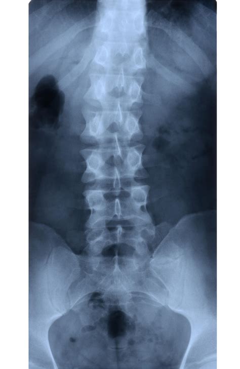 Coccyx Fracture Xray