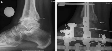 A This Is A Case Example Of A Patient That Underwent Ankle Distraction