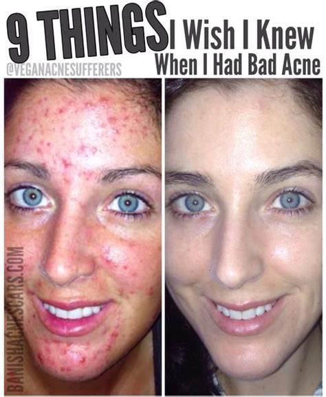 10 Things I Wish I Knew When I Had Bad Acne Bad Acne Teenage Acne