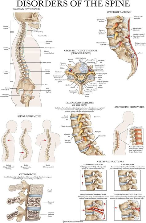 Palace Learning Disorders Of The Spine Anatomy Poster Laminated