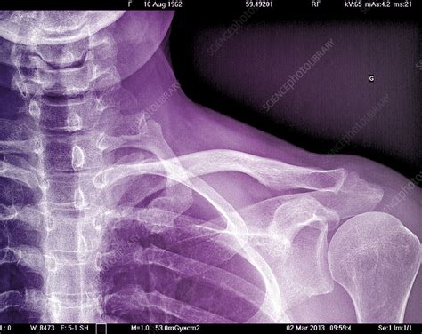 Collarbone X Ray Stock Image C0231283 Science Photo Library