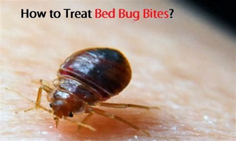 How To Treat Bed Bug Bites