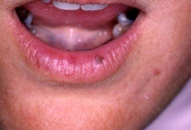 Oral Melanoma Symptoms Doctor Heck