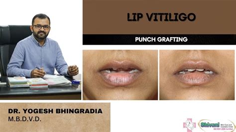 Lip Vitiligo Mini Punch Grafting Vitiligo Surgery Dr Yogesh