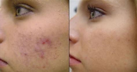 Ipl For Pigmented Lesions And Dark Spots Glamor Medical Blog